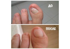 Обработка инфицированной/утолщенной ногтевой пластины (маленький палец)