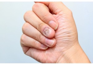 Обработка инфицированной/утолщенной ногтевой пластины на руке