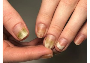 Обработка инфицированной/утолщенной ногтевой пластины