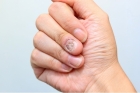 Обработка инфицированной/утолщенной ногтевой пластины на руке